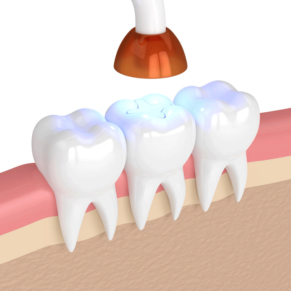illustration of dental fillings being sealed