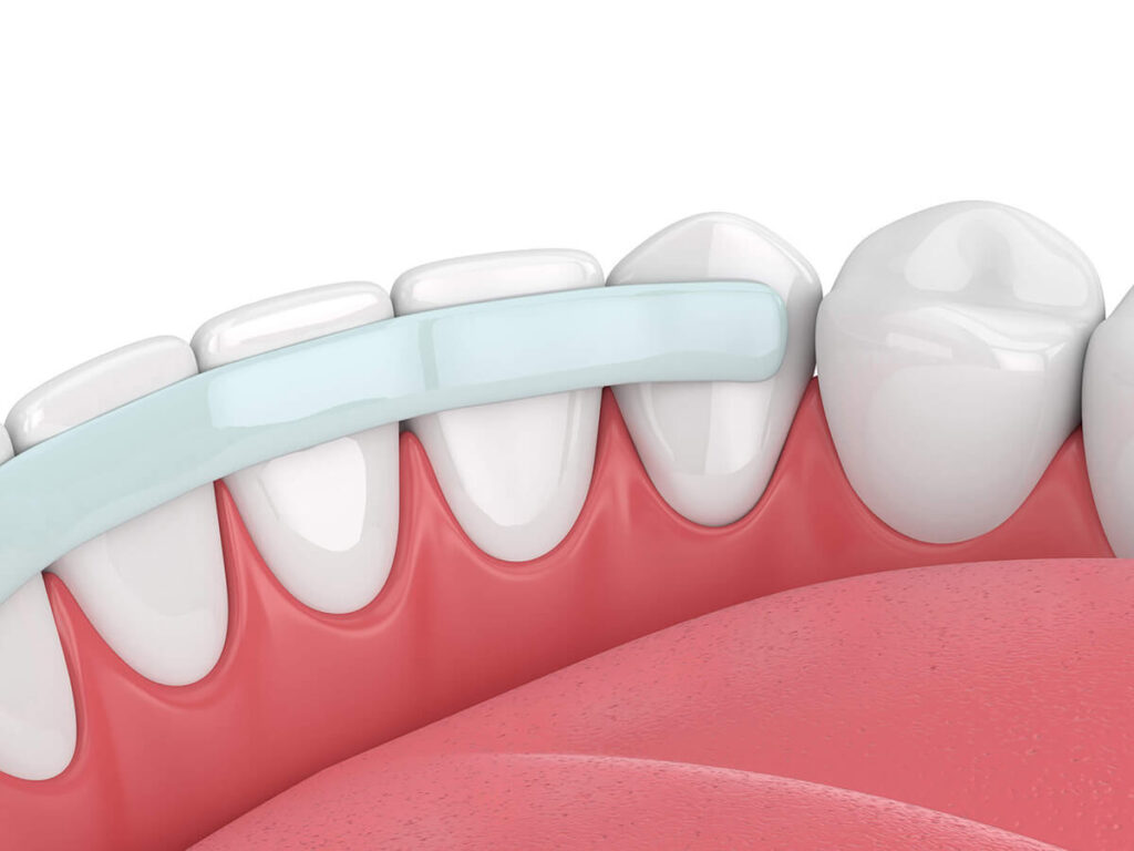 illustration of a dental bond